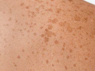 dr lee-mei yap dermatologist melbourne